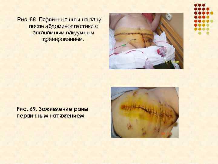 Рис. 68. Первичные швы на рану после абдоминопластики с автономным вакуумным дренированием. Рис. 69.