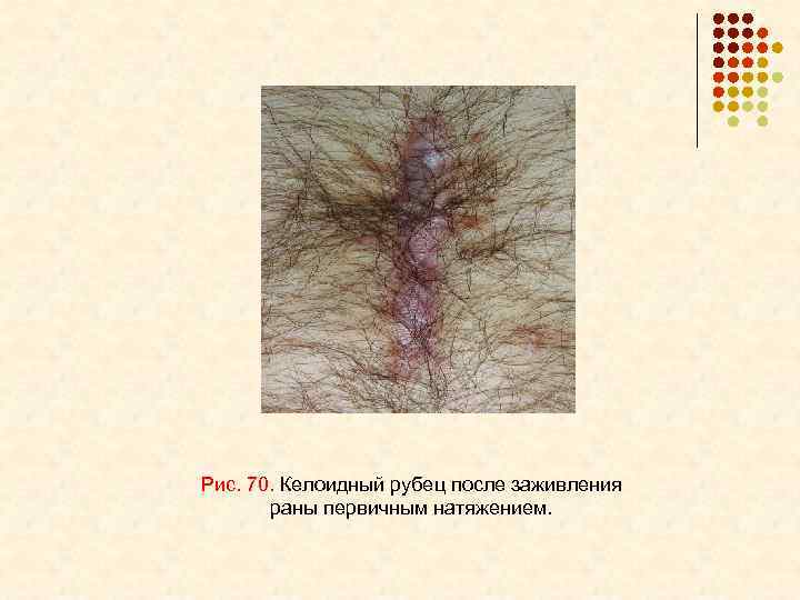 Рис. 70. Келоидный рубец после заживления раны первичным натяжением. 
