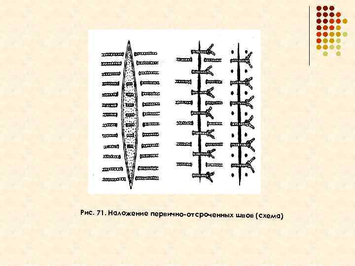 а Рис. 71. Наложение первично-отсроченных швов (схема) 
