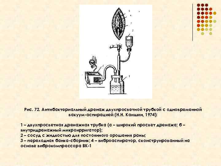 Рис. 72. Антибактериальный дренаж двухпросветной трубкой с одновременной вакуум-аспирацией (Н. Н. Каншин, 1974): 1