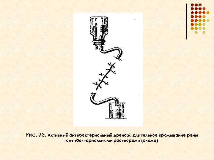 Рис. 73. Активный антибактериальный дренаж. Длительное промывание раны антибактериальными растворами (схема) 