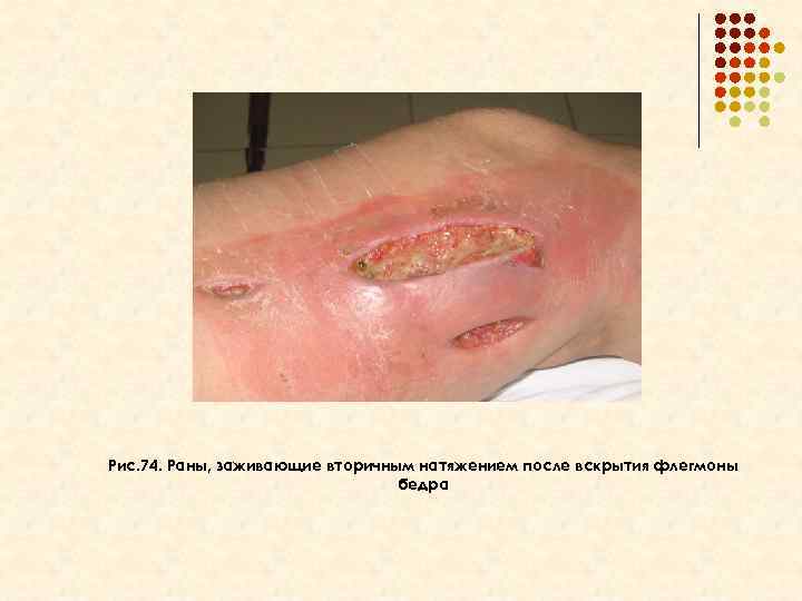 Рис. 74. Раны, заживающие вторичным натяжением после вскрытия флегмоны бедра 