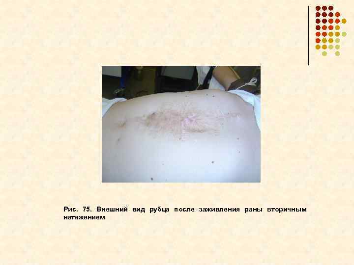 Рис. 75. Внешний вид рубца после заживления раны вторичным натяжением 