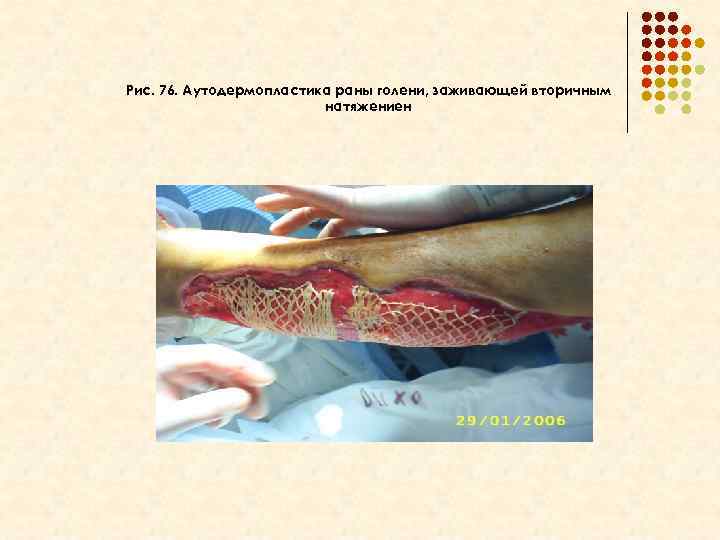 Рис. 76. Аутодермопластика раны голени, заживающей вторичным натяжениен 
