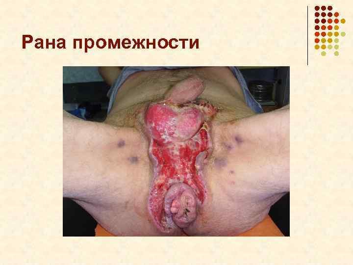 Рана промежности 