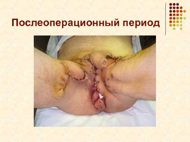 Послеоперационный период 
