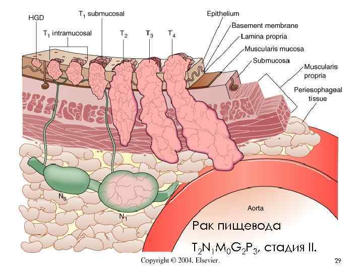 Рак пищевода T 2 N 1 M 0 G 2 Р 3, стадия II.