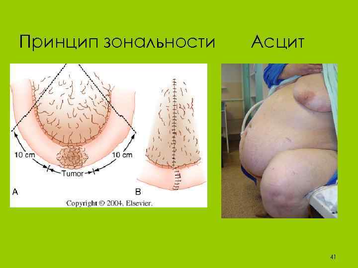 Принцип зональности Асцит 41 