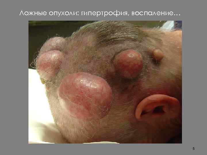 Ложные опухоли: гипертрофия, воспаление… 5 