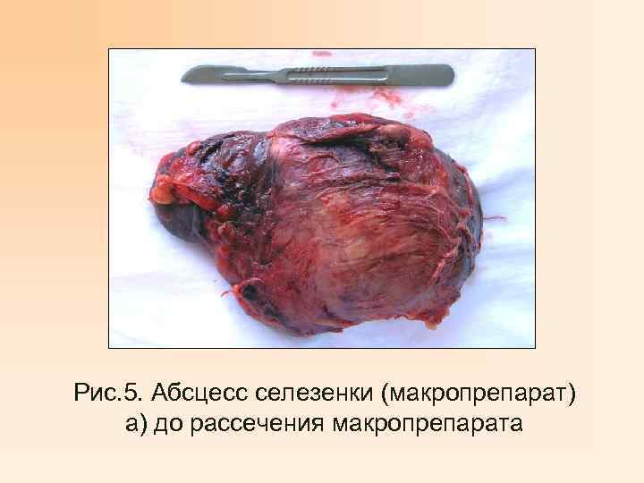 Рис. 5. Абсцесс селезенки (макропрепарат) а) до рассечения макропрепарата 