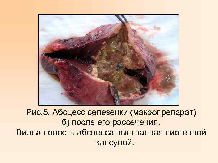 Рис. 5. Абсцесс селезенки (макропрепарат) б) после его рассечения. Видна полость абсцесса выстланная пиогенной