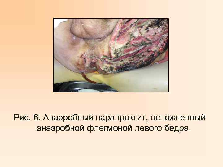 Рис. 6. Анаэробный парапроктит, осложненный анаэробной флегмоной левого бедра. 