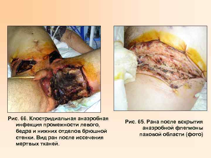 Рис. 66. Клостридиальная анаэробная инфекция промежности левого, бедра и нижних отделов брюшной стенки. Вид