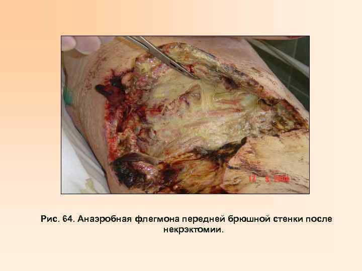 Рис. 64. Анаэробная флегмона передней брюшной стенки после некрэктомии. 