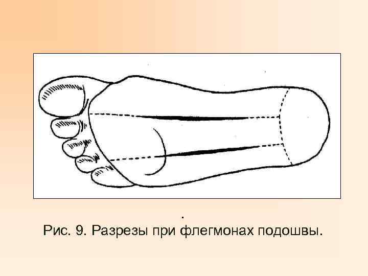 . Рис. 9. Разрезы при флегмонах подошвы. 
