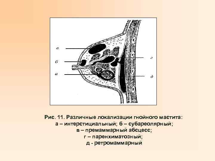 Рис. 11. Различные локализации гнойного мастита: а – интерстициальный; б – субареолярный; в –