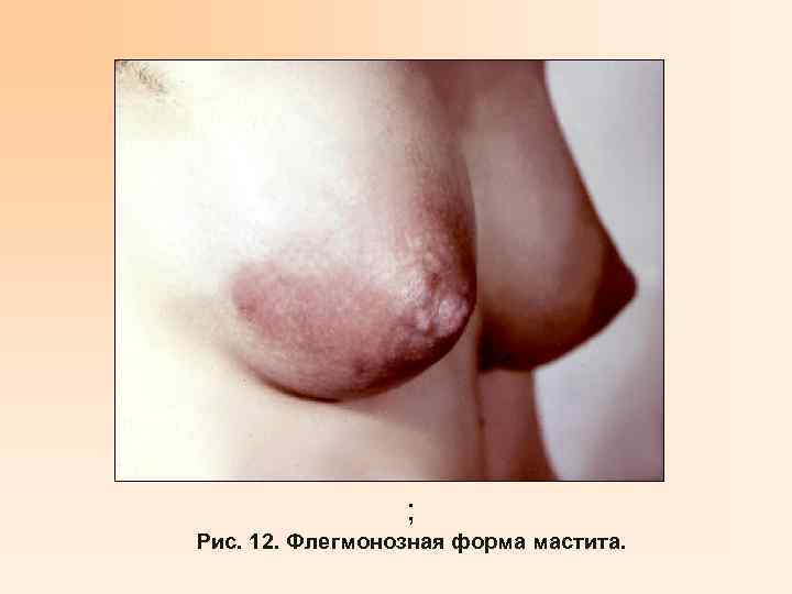 ; Рис. 12. Флегмонозная форма мастита. 