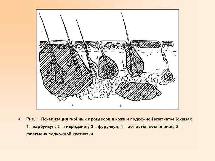 l Рис. 1. Локализация гнойных процессов в коже и подкожной клетчатке (схема): 1 –