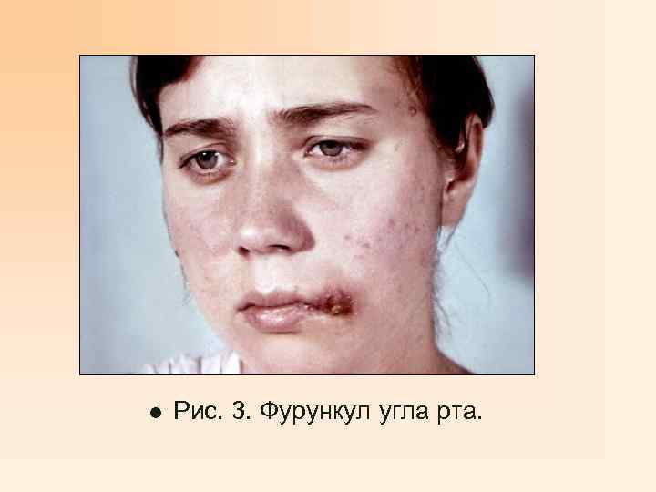 l Рис. 3. Фурункул угла рта. 