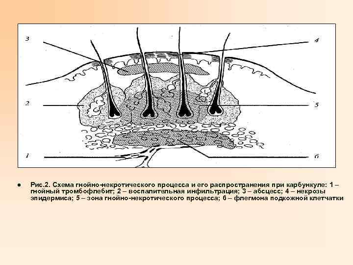 l Рис. 2. Схема гнойно-некротического процесса и его распространения при карбункуле: 1 – гнойный