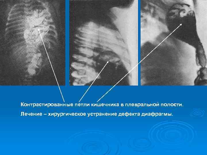 Контрастированные петли кишечника в плевральной полости. Лечение – хирургическое устранение дефекта диафрагмы. 