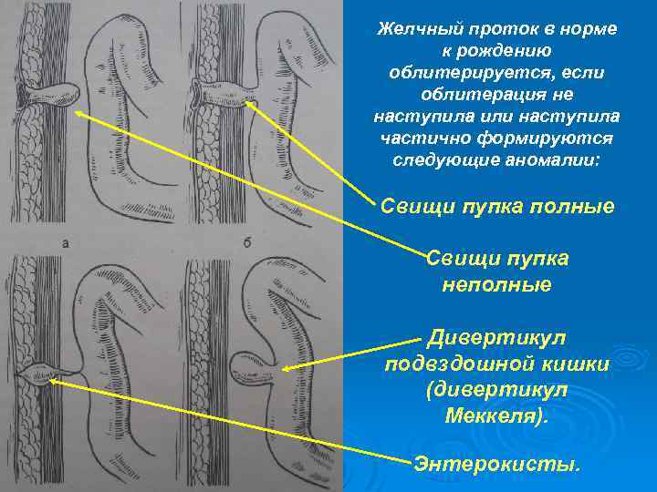 Свищ урахуса. Пороки развития пуповины.