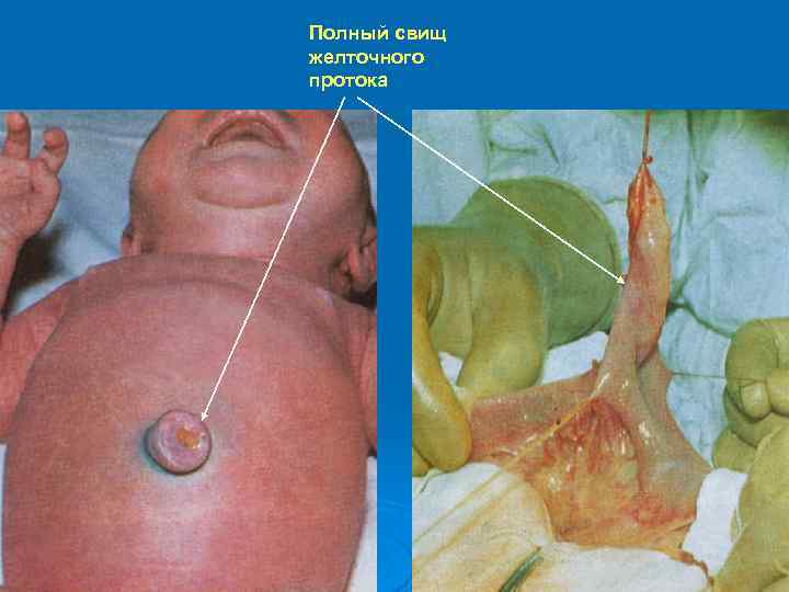 Полный свищ желточного протока 