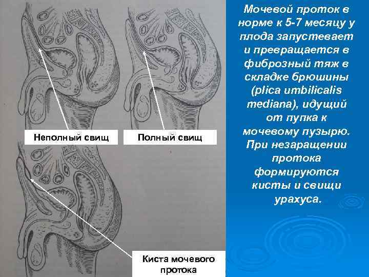 Неполный свищ Полный свищ Киста мочевого протока Мочевой проток в норме к 5 -7