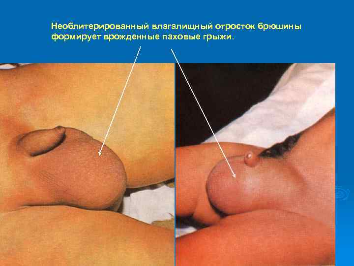 Необлитерированный влагалищный отросток брюшины формирует врожденные паховые грыжи. 
