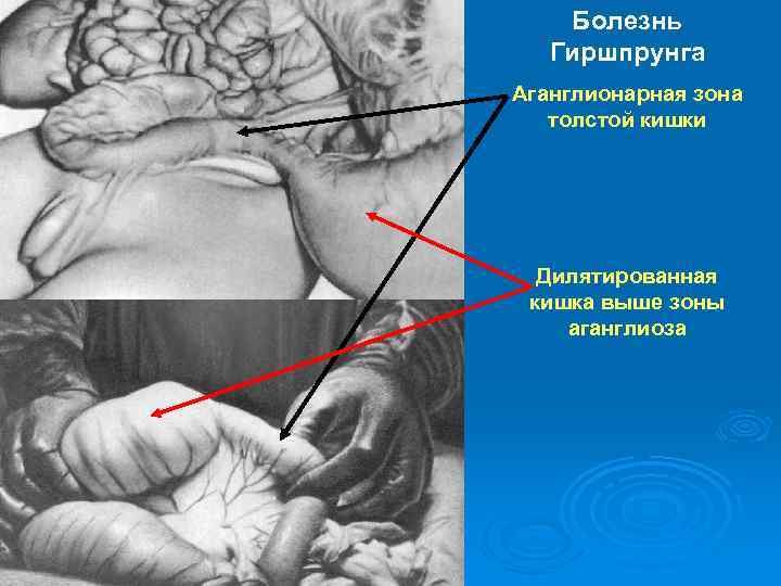 Болезнь Гиршпрунга Аганглионарная зона толстой кишки Дилятированная кишка выше зоны аганглиоза 