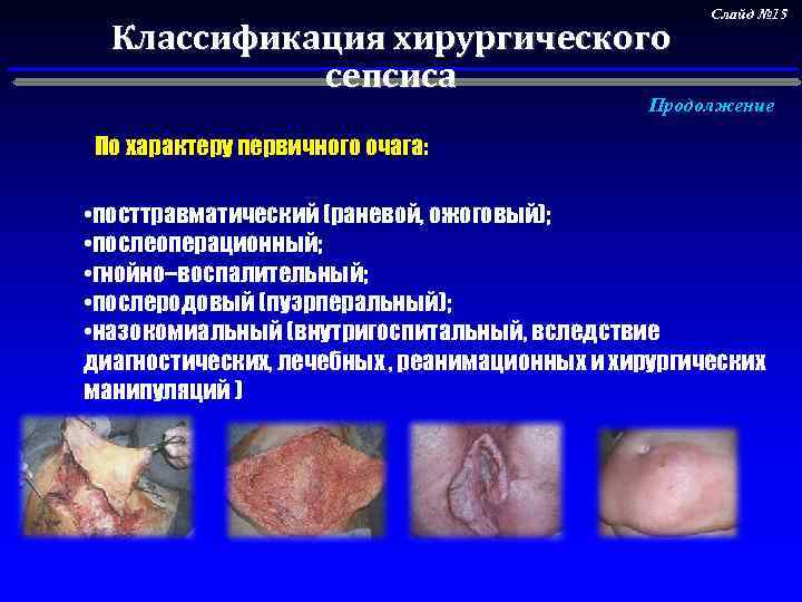 Классификация хирургического сепсиса Слайд № 15 Продолжение По характеру первичного очага: • посттравматический (раневой,