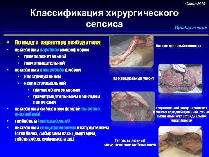 Слайд № 16 Классификация хирургического сепсиса Продолжение • По виду и характеру возбудителя: •