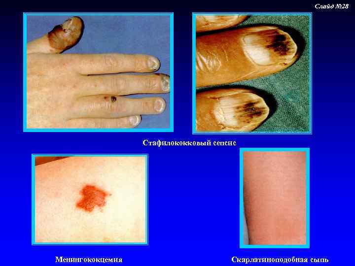 Слайд № 28 Стафилококковый сепсис Менингококцемия Скарлатиноподобная сыпь 
