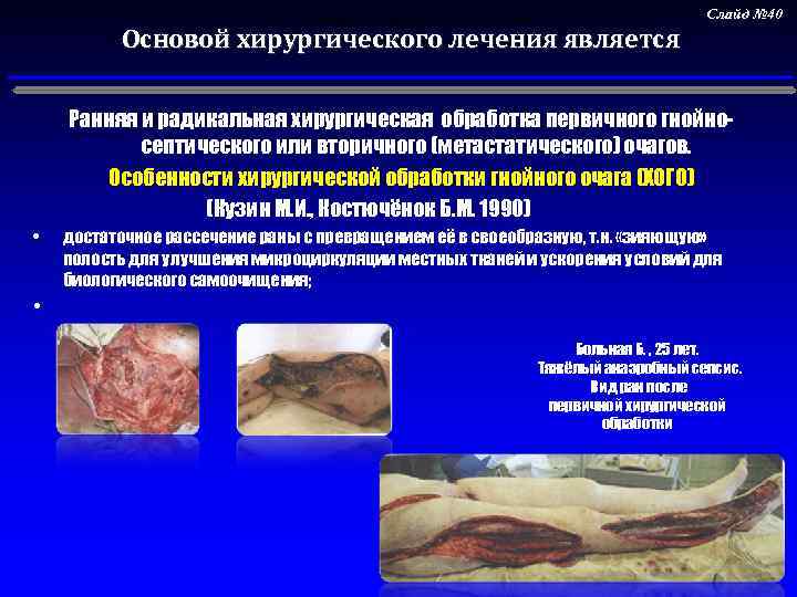  • фасциотомия для декомпрессии тканей; Основой хирургического лечения является Слайд № 40 Ранняя