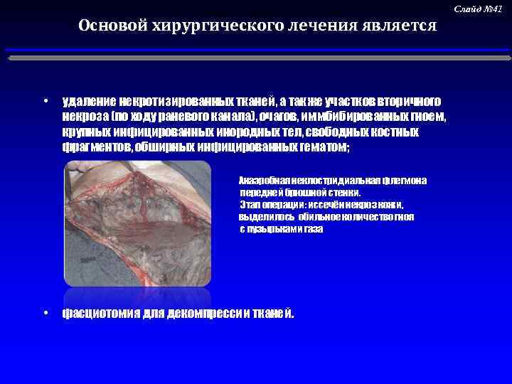  • фасциотомия для декомпрессии тканей; Основой хирургического лечения является • удаление некротизированных тканей,