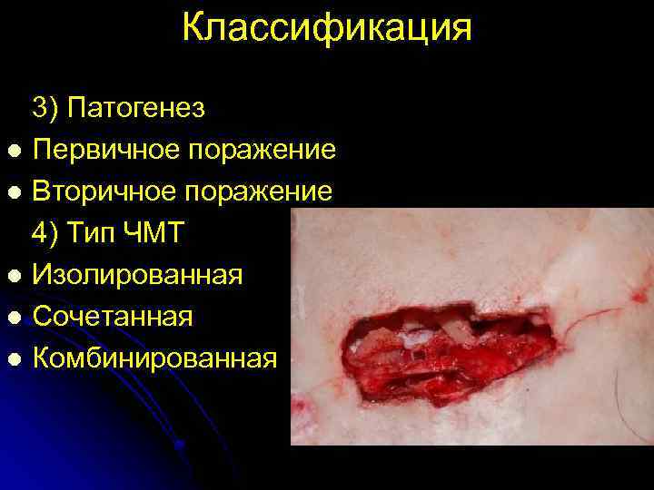 Классификация l l l 3) Патогенез Первичное поражение Вторичное поражение 4) Тип ЧМТ Изолированная