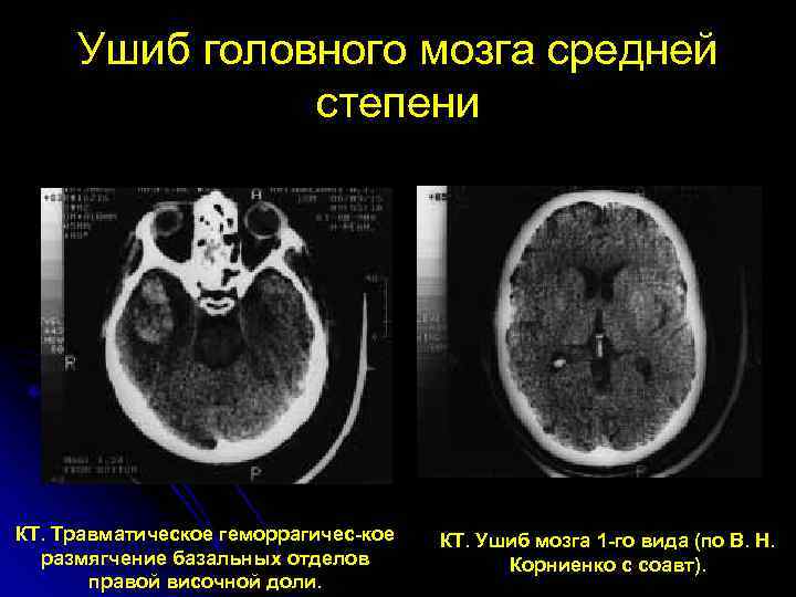 Кт при сотрясении головного мозга