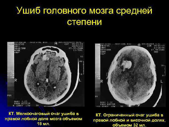 Гематома черепно мозговой травме. Черепно мозговая травма кт и мрт. Ушиб головного мозга средней степени кт. Ушиб головного мозга средней степени тяжести кт. Ушиб головного мозга тяжелой степени тяжести кт.
