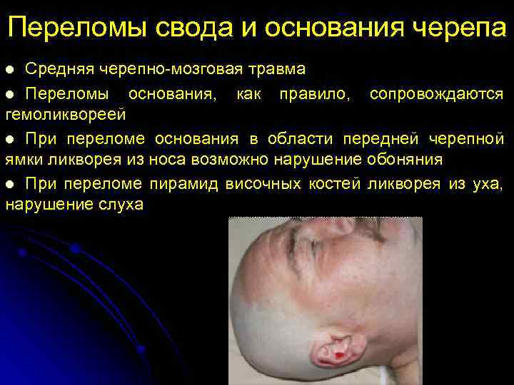 Переломы свода и основания черепа Средняя черепно-мозговая травма l Переломы основания, как правило, сопровождаются