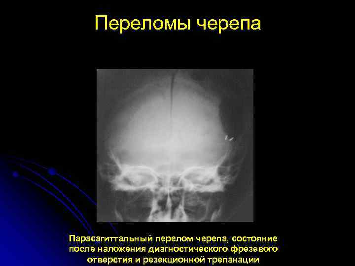 Переломы черепа Парасагиттальный перелом черепа, состояние после наложения диагностического фрезевого отверстия и резекционной трепанации