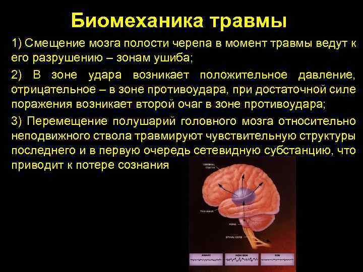 Биомеханика травмы 1) Смещение мозга полости черепа в момент травмы ведут к его разрушению