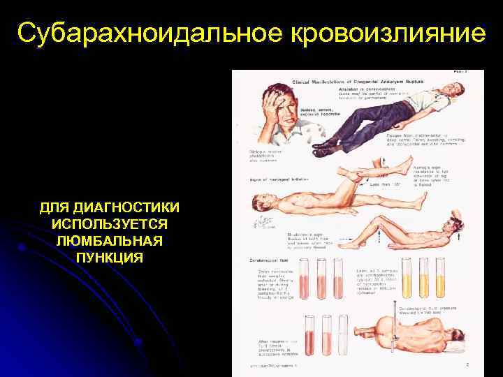 Субарахноидальное кровоизлияние ДЛЯ ДИАГНОСТИКИ ИСПОЛЬЗУЕТСЯ ЛЮМБАЛЬНАЯ ПУНКЦИЯ 