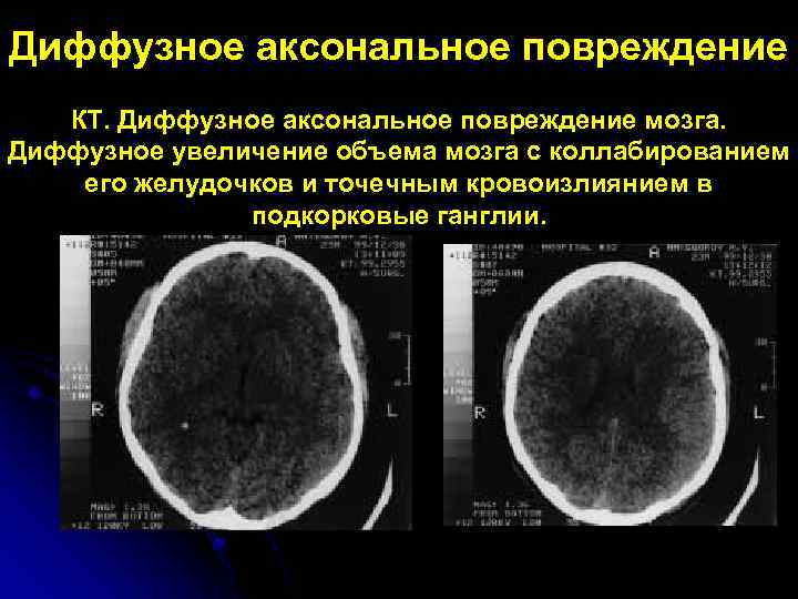 Диффузное аксональное повреждение мозга