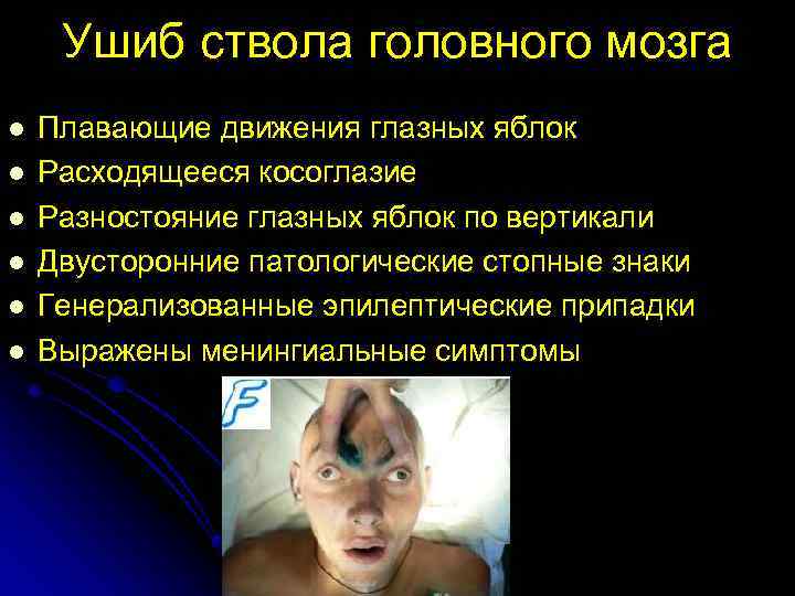 Ушиб ствола головного мозга l l l Плавающие движения глазных яблок Расходящееся косоглазие Разностояние