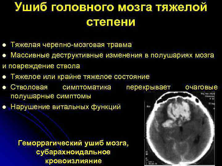 Тяжести сотрясение мозга. Ушиб головного мозга средней степени. Ушиб головного мозга степени тяжести. Черепно-мозговая травма ушиб головного мозга.