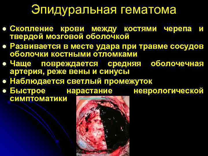 Эпидуральная гематома l l l Скопление крови между костями черепа и твердой мозговой оболочкой