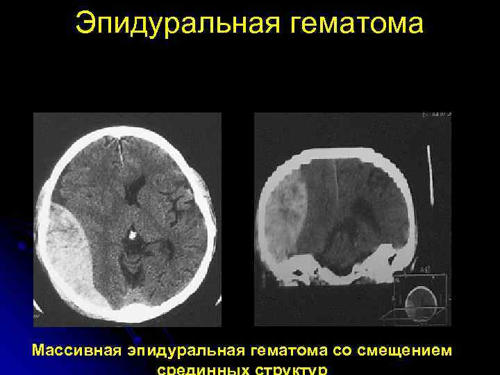 Эпидуральная гематома Массивная эпидуральная гематома со смещением 