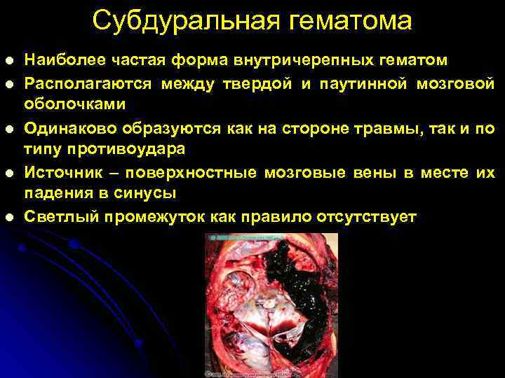 Субдуральная гематома l l l Наиболее частая форма внутричерепных гематом Располагаются между твердой и