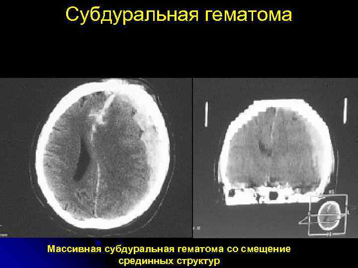 Субдуральная гематома Массивная субдуральная гематома со смещение срединных структур 
