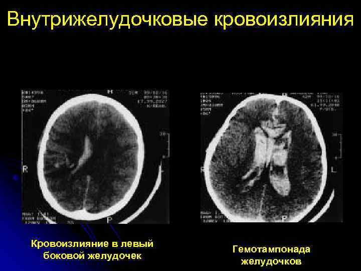 Внутрижелудочковые кровоизлияния Кровоизлияние в левый боковой желудочек Гемотампонада желудочков 